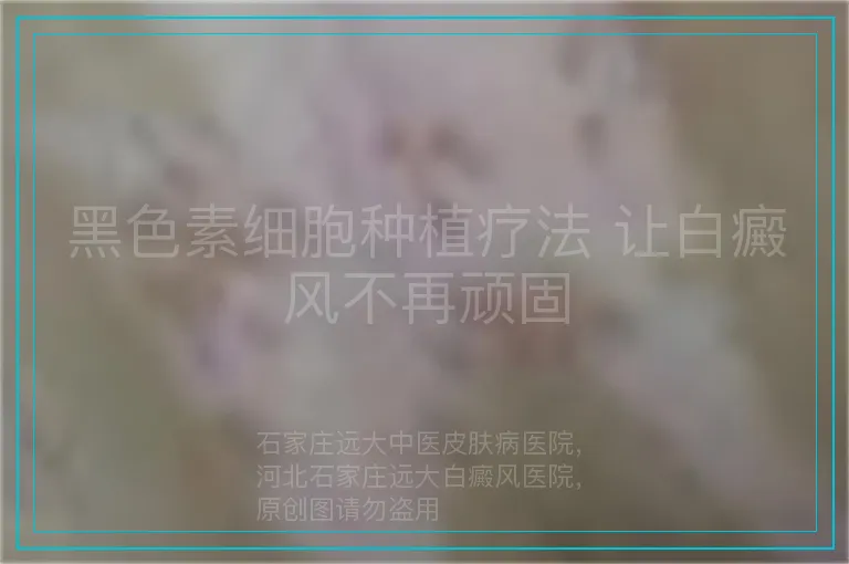 黑色素细胞种植疗法 让白癜风不再顽固