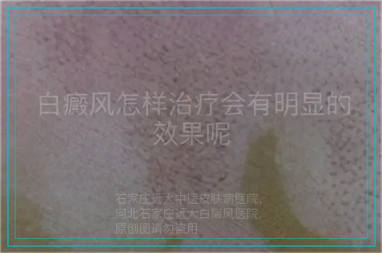 白癜风怎样治疗会有明显的效果呢