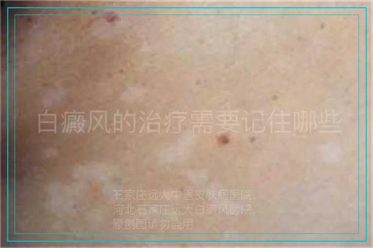 白癜风的治疗需要记住哪些
