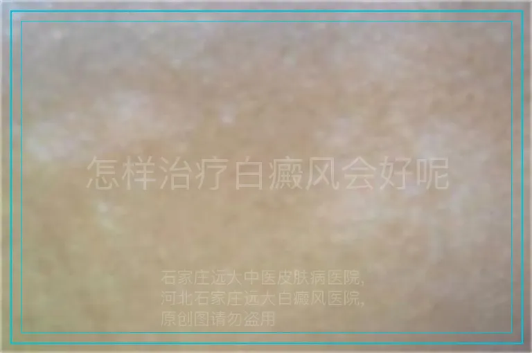 怎样治疗白癜风会好呢