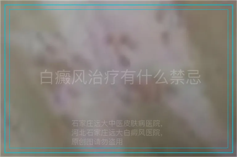 白癜风治疗有什么禁忌