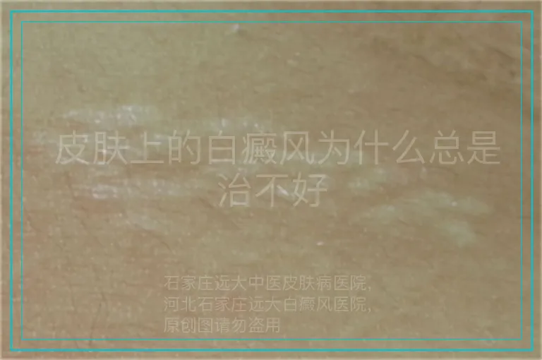 皮肤上的白癜风为什么总是治不好