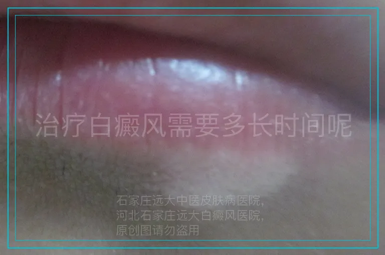 治疗白癜风需要多长时间呢