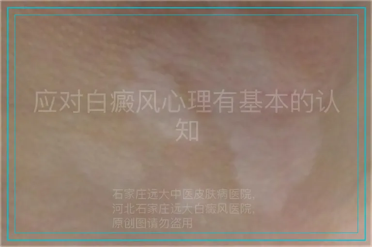 应对白癜风心理有基本的认知