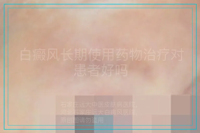 白癜风长期使用药物治疗对患者好吗