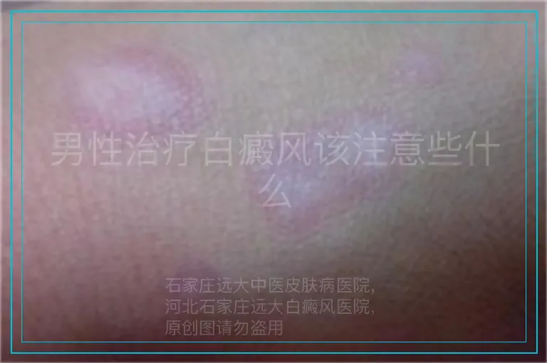男性治疗白癜风该注意些什么