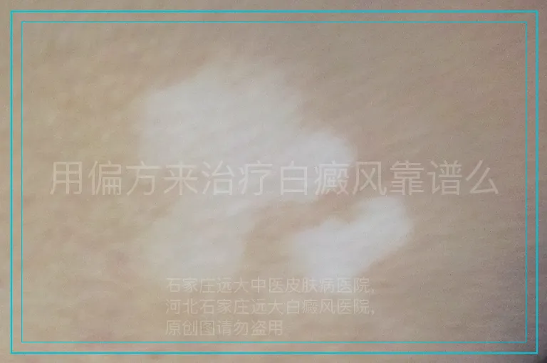 用偏方来治疗白癜风靠谱么