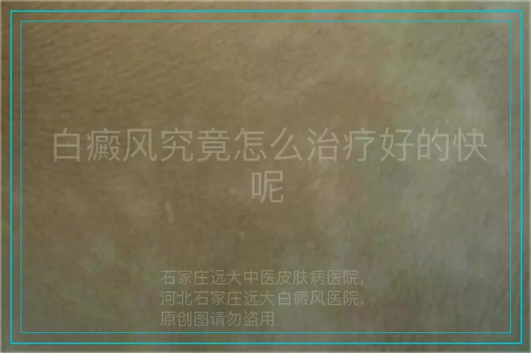 白癜风究竟怎么治疗好的快呢