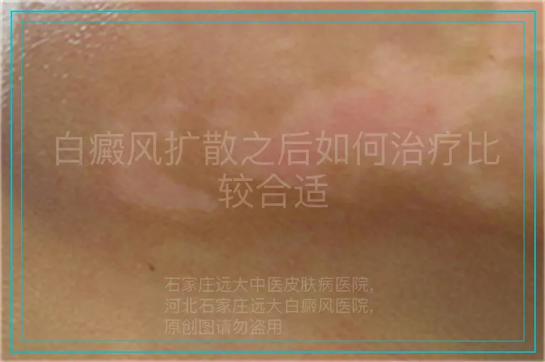白癜风扩散之后如何治疗比较合适