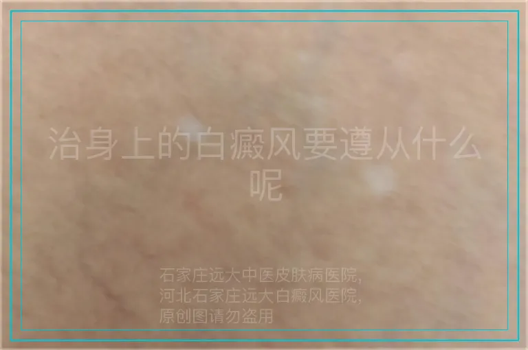 治身上的白癜风要遵从什么呢