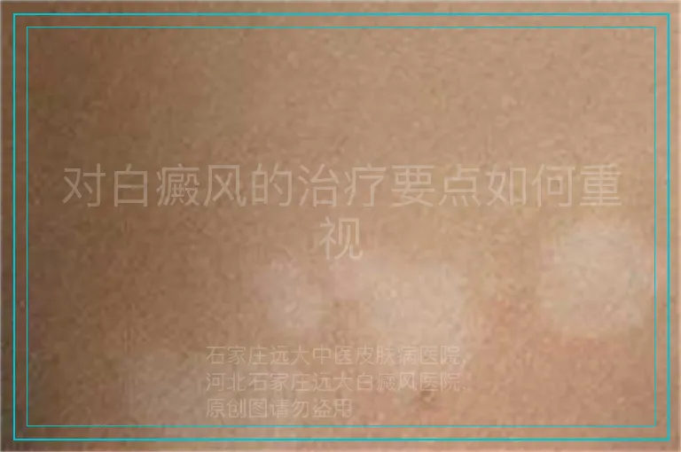 对白癜风的治疗要点如何重视