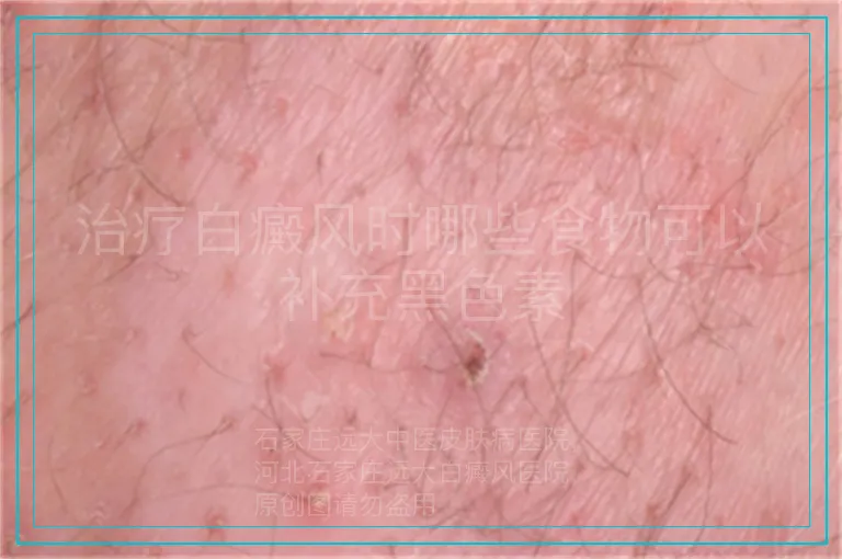 治疗白癜风时哪些食物可以补充黑色素