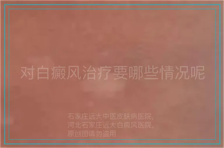 对白癜风治疗要哪些情况呢
