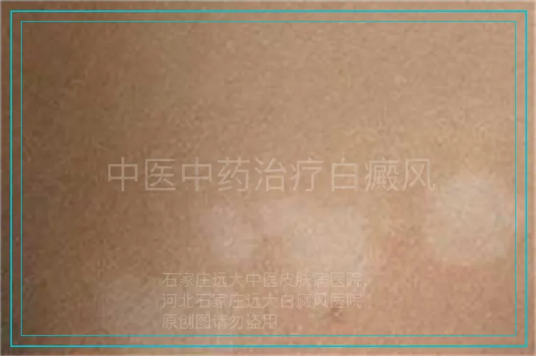 中医中药治疗白癜风