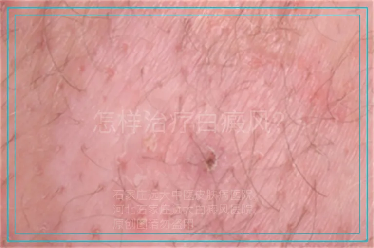 怎样治疗白癜风?