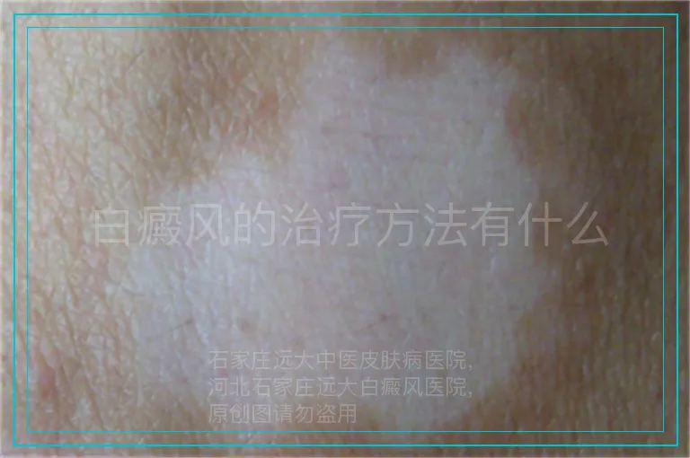 白癜风的治疗方法有什么