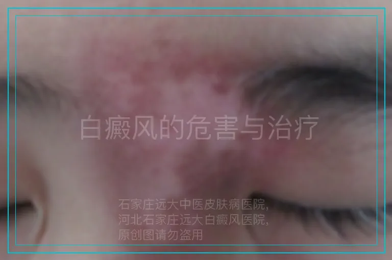 白癜风的危害与治疗