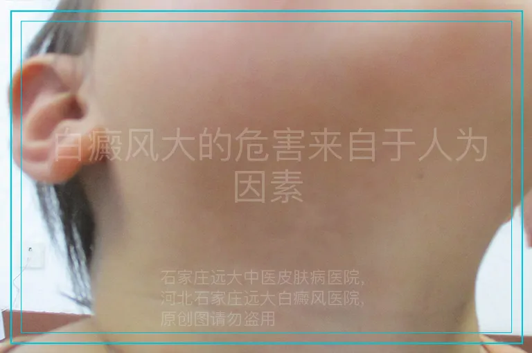 白癜风大的危害来自于人为因素