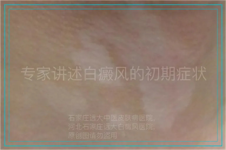 专家讲述白癜风的初期症状