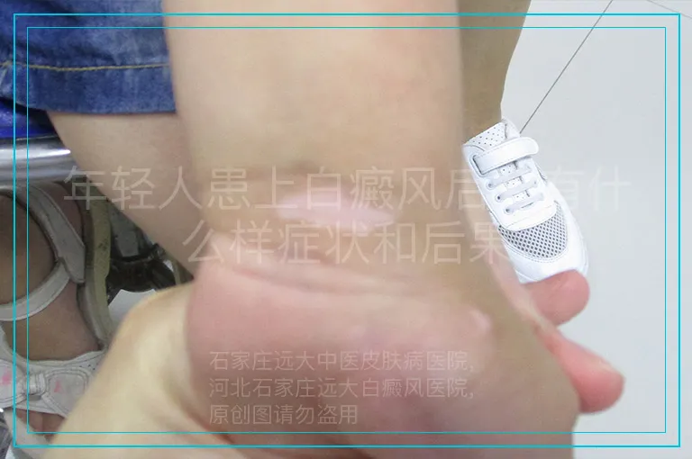 年轻人患上白癜风后会有什么样症状和后果
