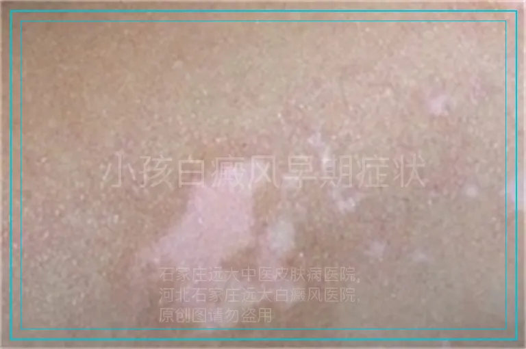 小孩白癜风早期症状