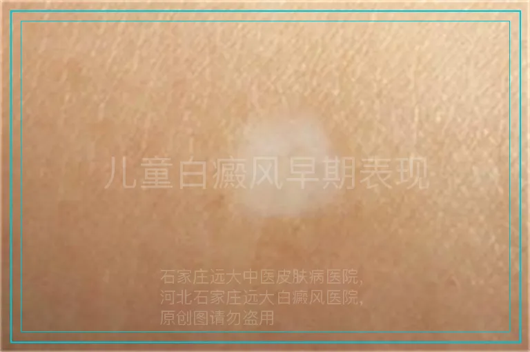 儿童白癜风早期表现