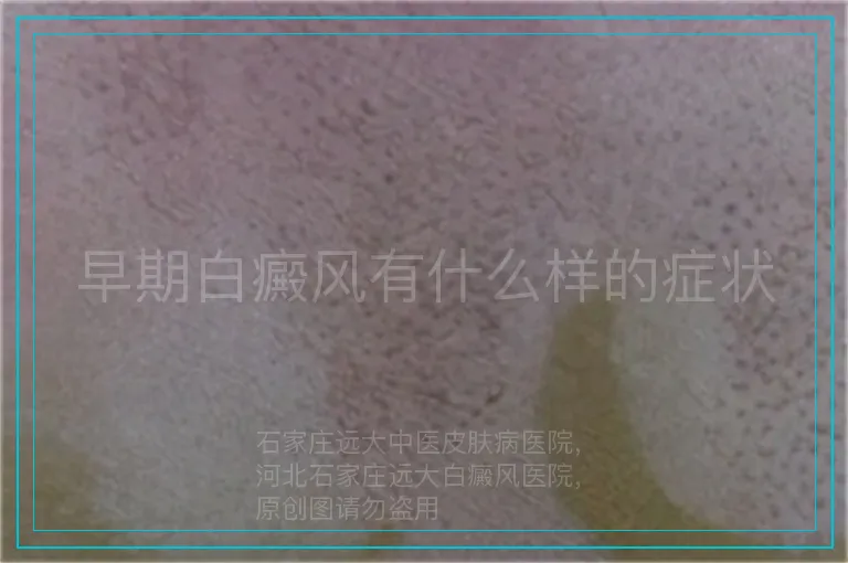 早期白癜风有什么样的症状
