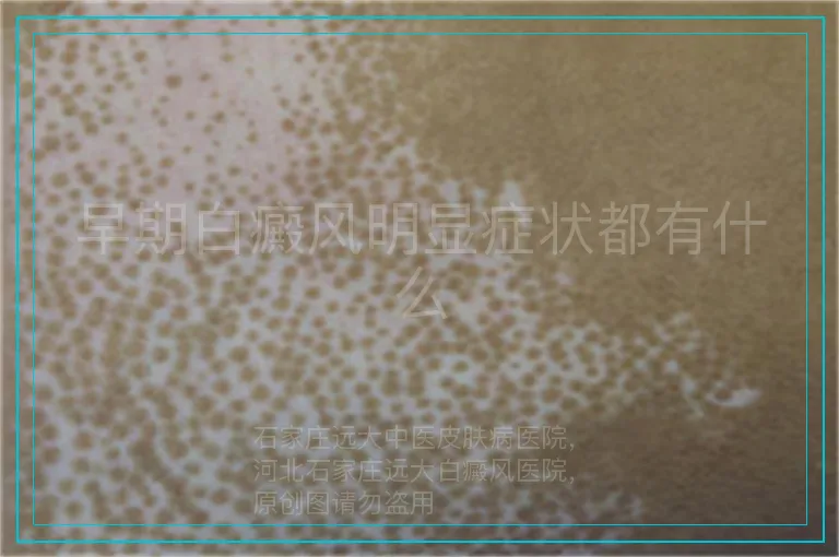 早期白癜风明显症状都有什么