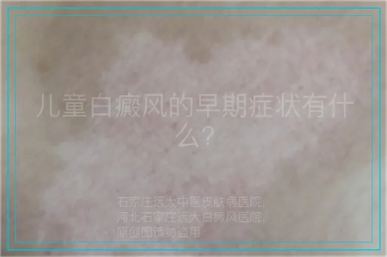儿童白癜风的早期症状有什么?