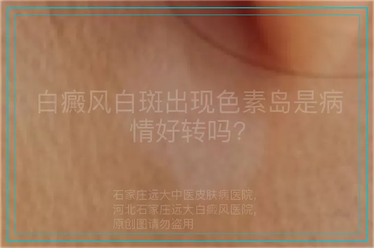 白癜风白斑出现色素岛是病情好转吗?