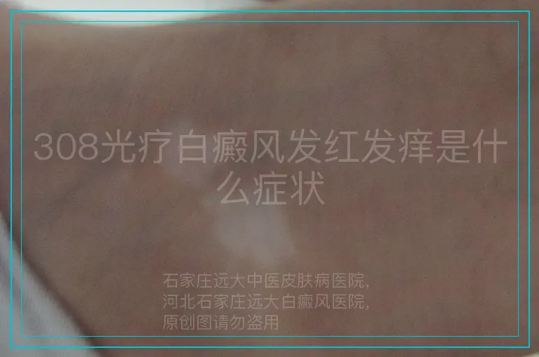 308光疗白癜风发红发痒是什么症状