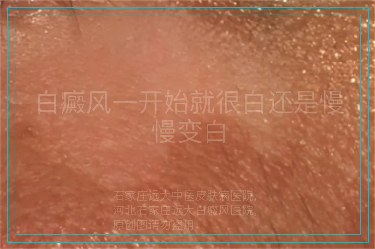 白癜风一开始就很白还是慢慢变白