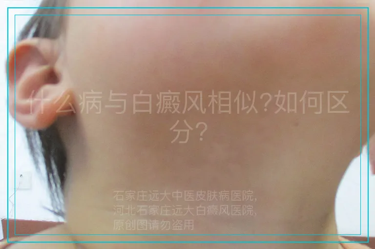 什么病与白癜风相似?如何区分?
