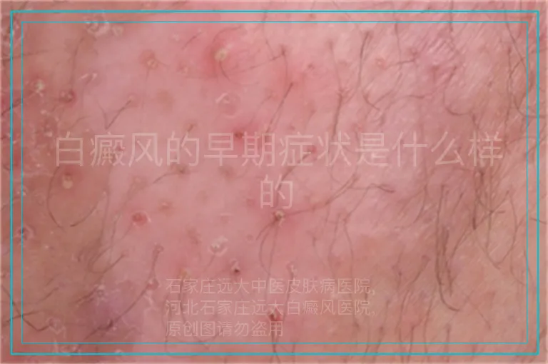 白癜风的早期症状是什么样的