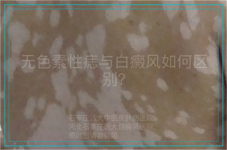 无色素性痣与白癜风如何区别？