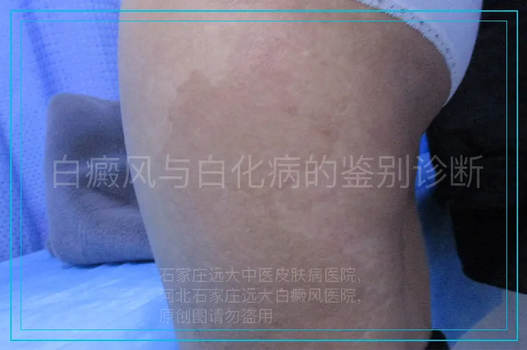 白癜风与白化病的鉴别诊断