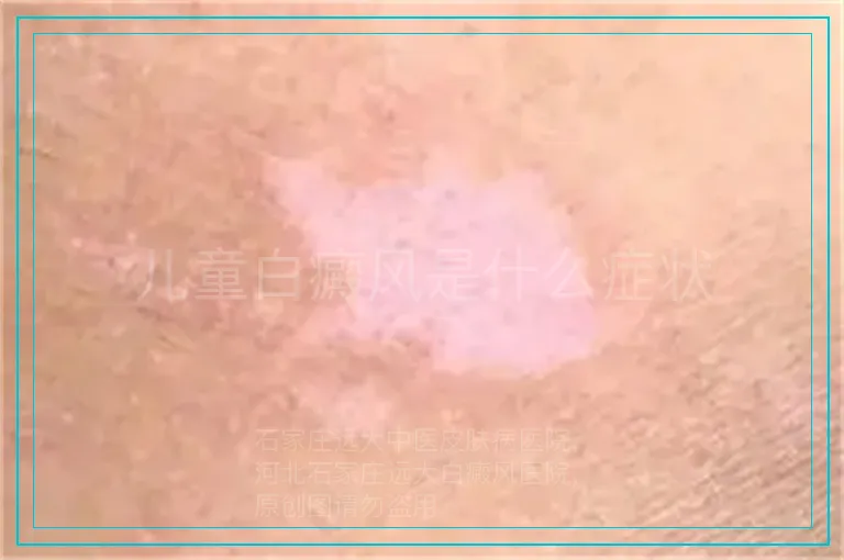 儿童白癜风是什么症状