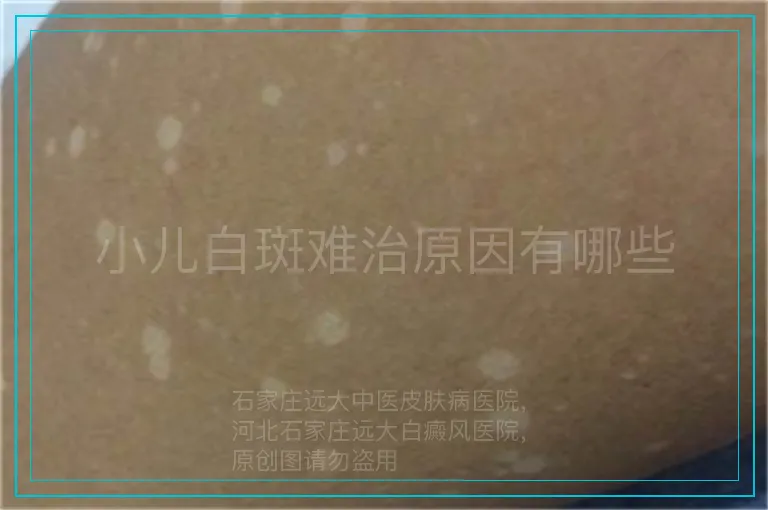 小儿白斑难治原因有哪些