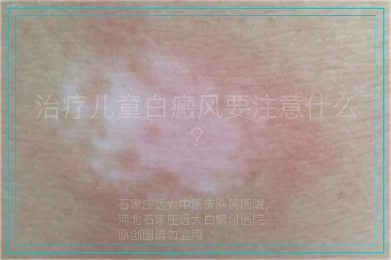 治疗儿童白癜风要注意什么?