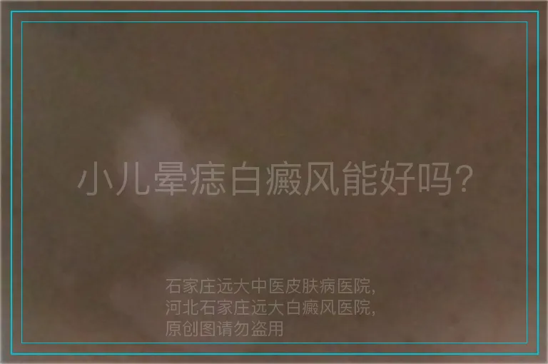 小儿晕痣白癜风能好吗?