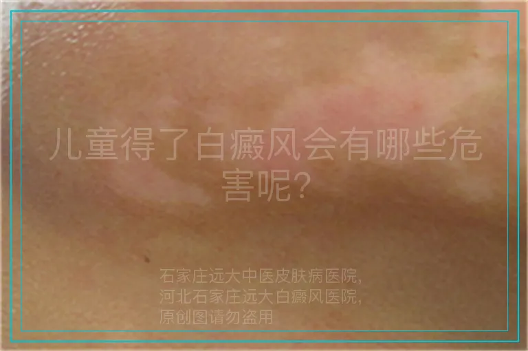 儿童得了白癜风会有哪些危害呢?