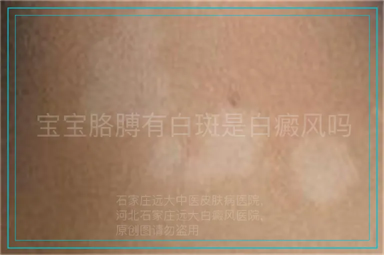 宝宝胳膊有白斑是白癜风吗