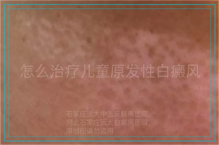 怎么治疗儿童原发性白癜风
