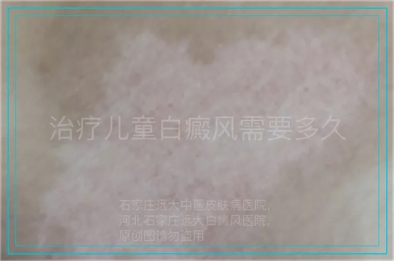 治疗儿童白癜风需要多久