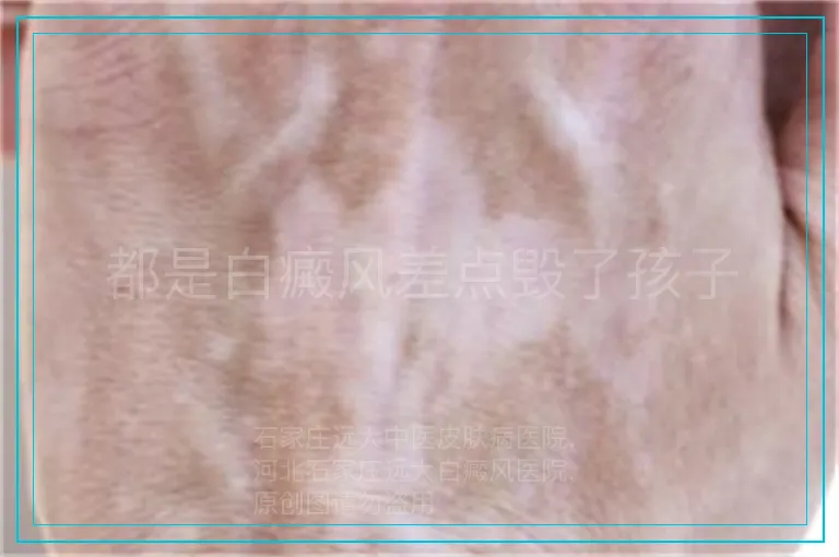 都是白癜风差点毁了孩子