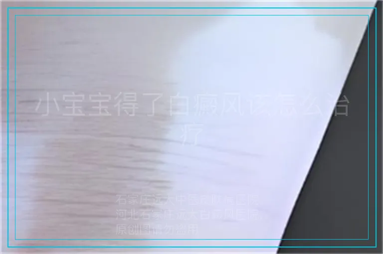 小宝宝得了白癜风该怎么治疗