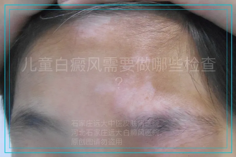 儿童白癜风需要做哪些检查?