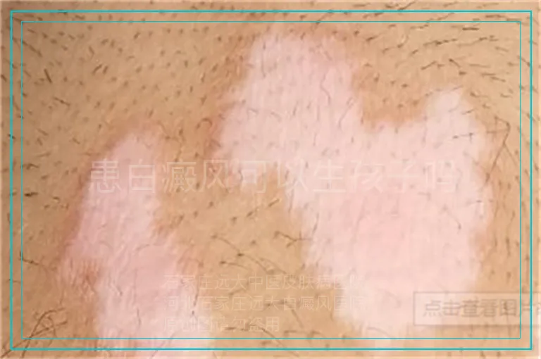 患白癜风可以生孩子吗