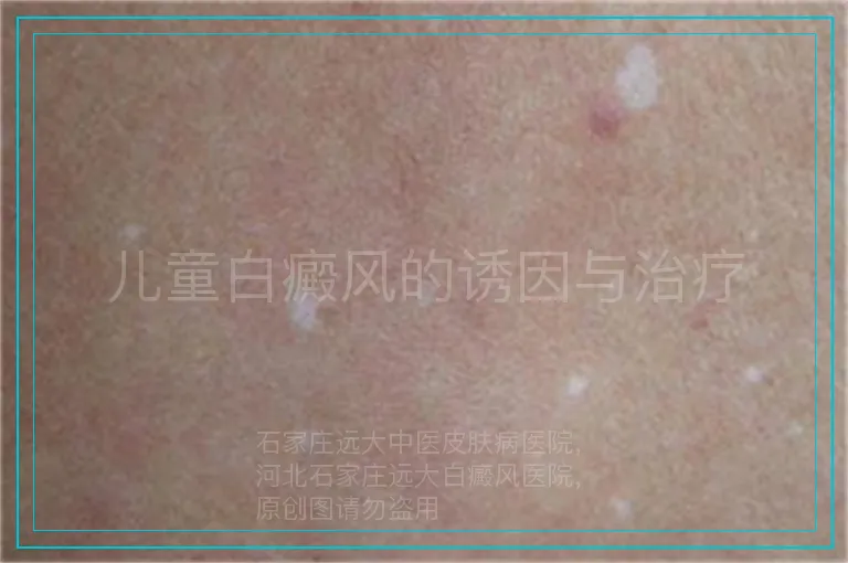 儿童白癜风的诱因与治疗