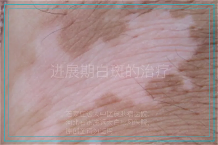进展期白斑的治疗
